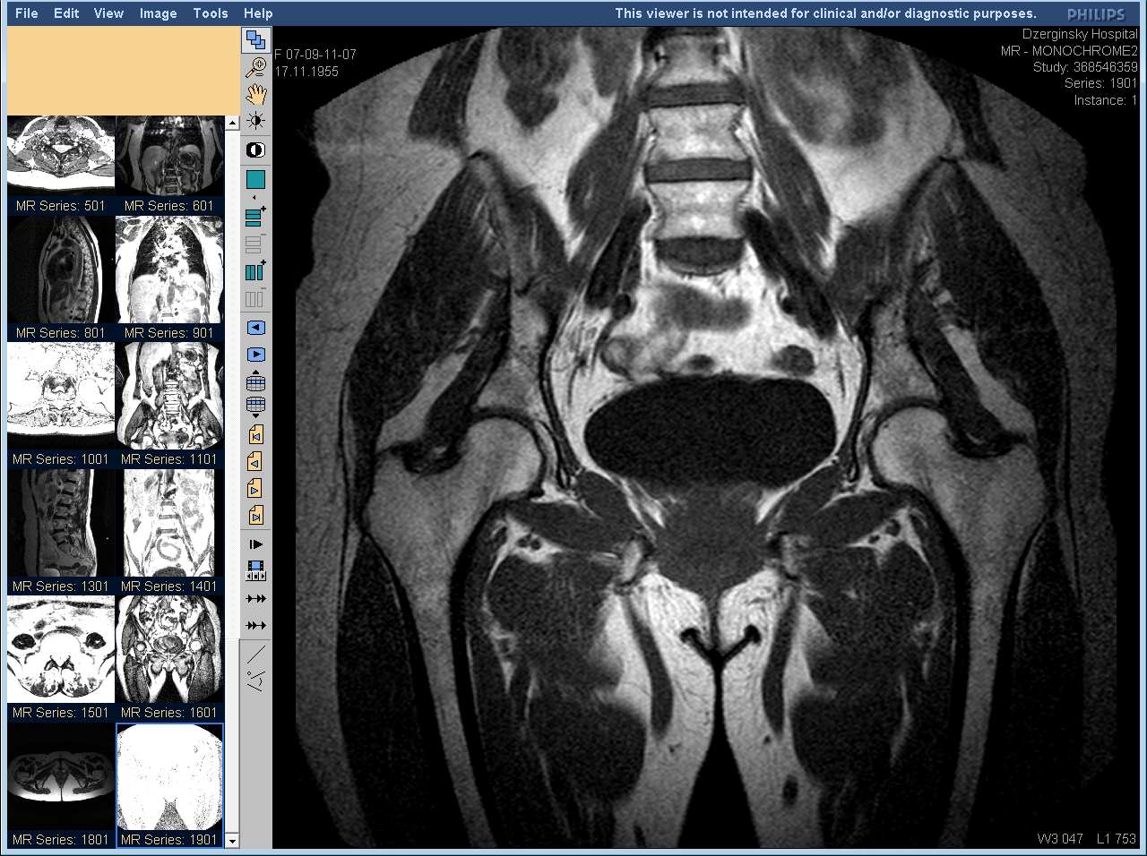 Магнитно-резонансная томография (МРТ) тазобедренного сустава